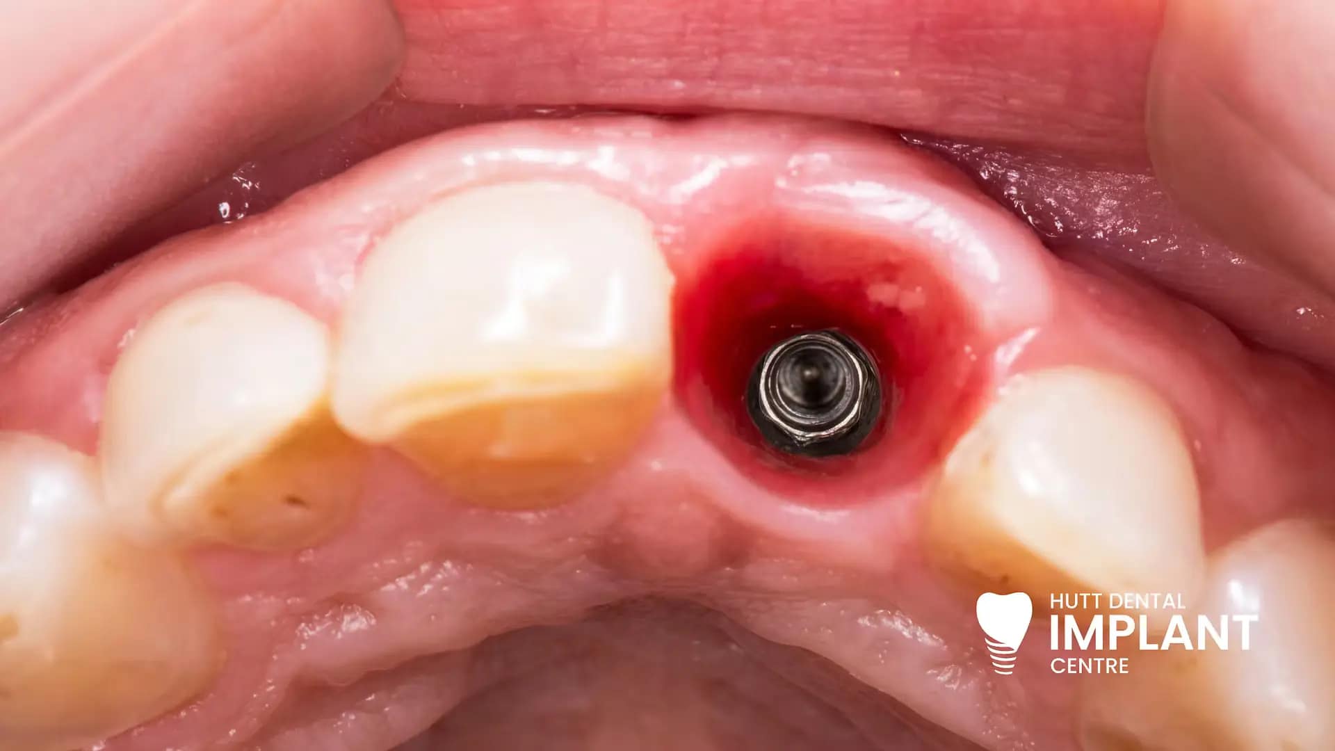 HDIC - How Long Do Dental Implants Last in New Zealand