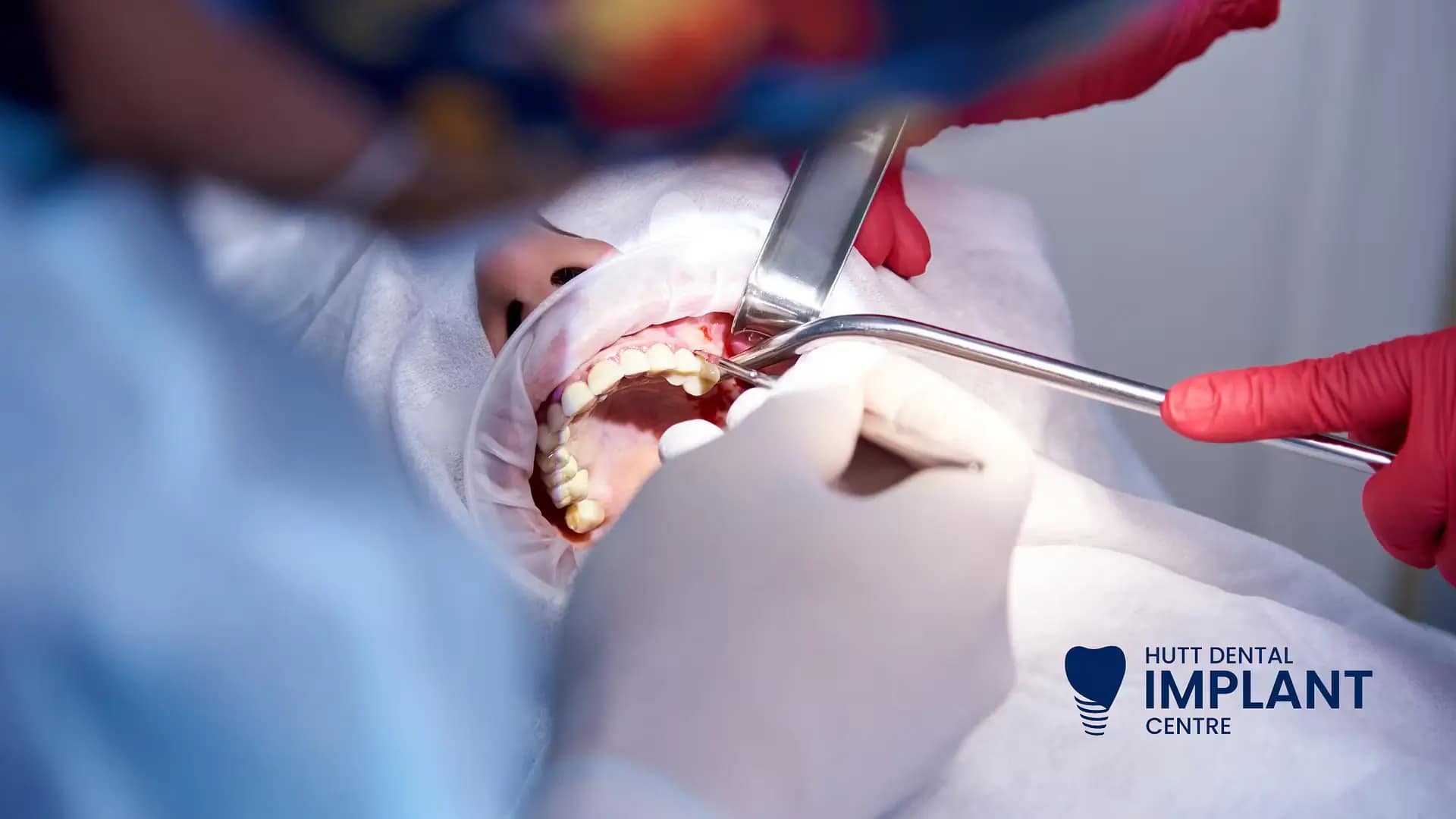 HDIC - Dental Implant Recovery